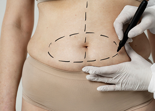 liposuction-procedure2